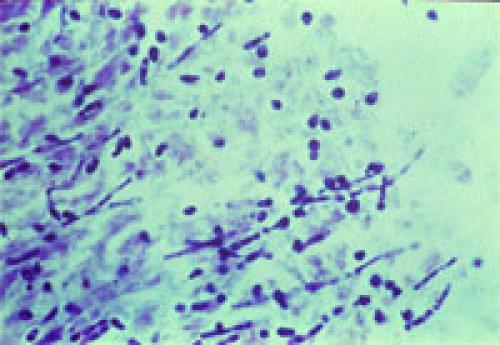 Как вывести грибок в квартире. Как не допустить появления грибка 03 Как вывести грибок в квартире. Как не допустить появления грибка 03