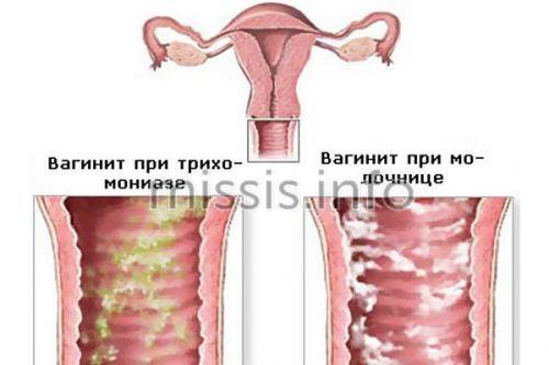 Противомикробные препараты для системного применения. Метронидазол / Metronidazole 05 Противомикробные препараты для системного применения. Метронидазол / Metronidazole 05