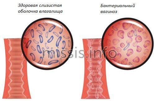 Противомикробные препараты для системного применения. Метронидазол / Metronidazole 04 Противомикробные препараты для системного применения. Метронидазол / Metronidazole 04