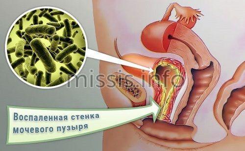 Противомикробные препараты для системного применения. Метронидазол / Metronidazole 03 Противомикробные препараты для системного применения. Метронидазол / Metronidazole 03