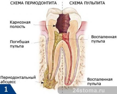 Антибиотики в стоматологии при периодонтите. Лечение периодонтита: цена, этапы